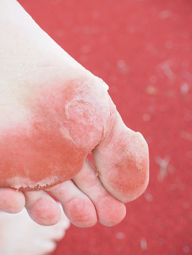 Das passiert tatsächlich, wenn man Flip-Flops trägt